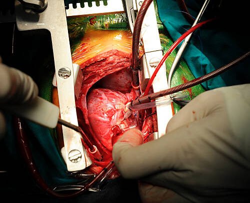 Chirurgie Cardio-Vasculaire