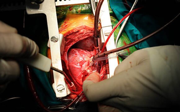Chirurgie Cardio-Vasculaire